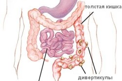 Схема дивертикулеза сигмовидной кишки