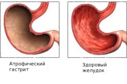 Здоровый желудок и желудок с атрофическим гастритом