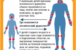 Места проявления дерматита
