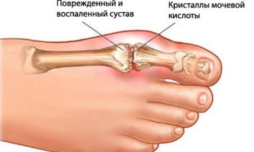 Схема подагрического артрита