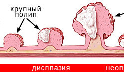 Стадии развития рака