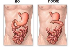 Желудок до и после резекции