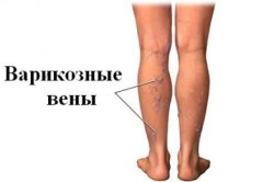 Варикозное расширение вен при лишнем весе
