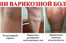 Варикоз - противопоказание к приему гематогена